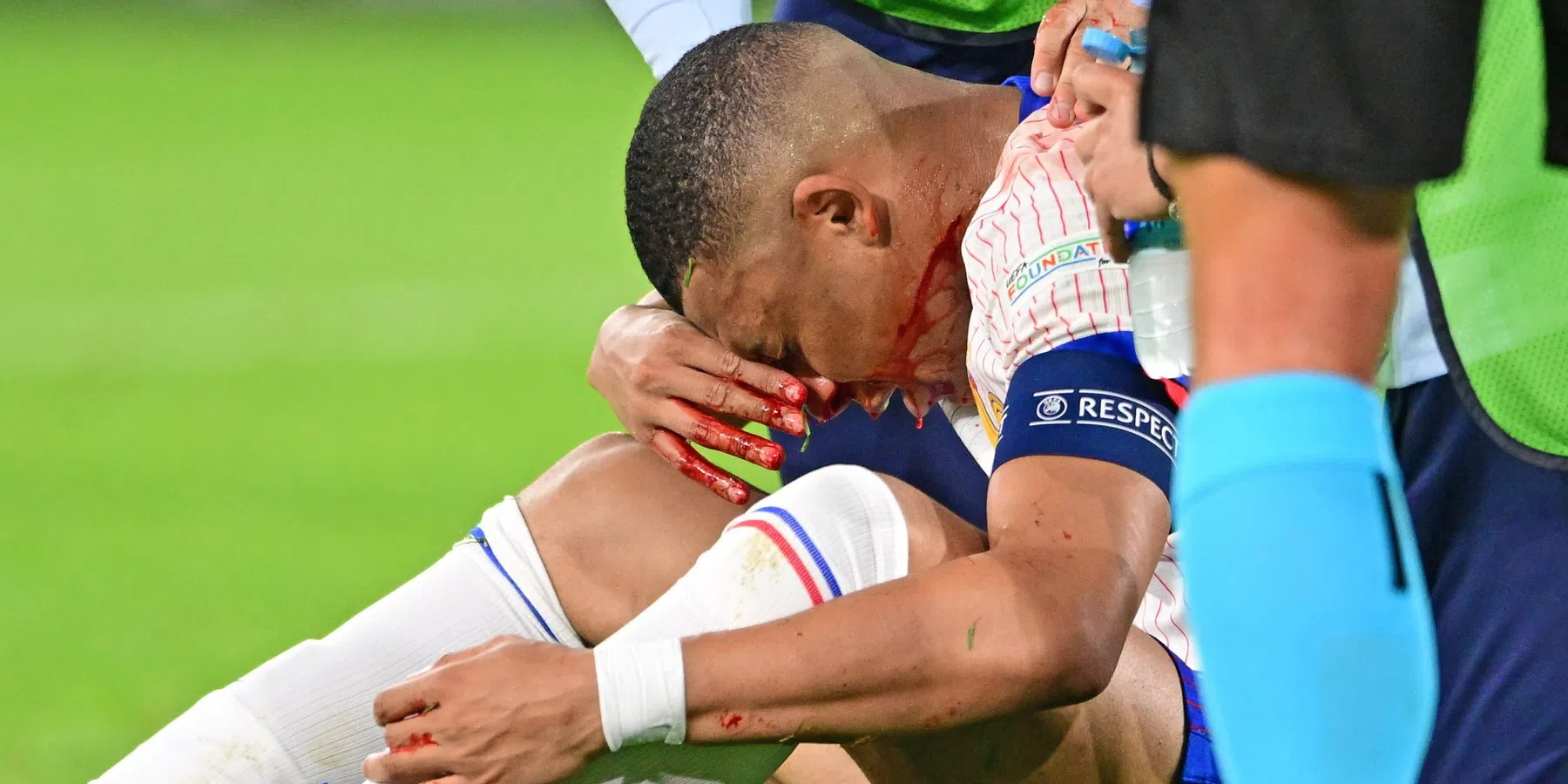 L'Équipe: Mbappé moet onder het mes voor duel met Oranje door gebroken neus